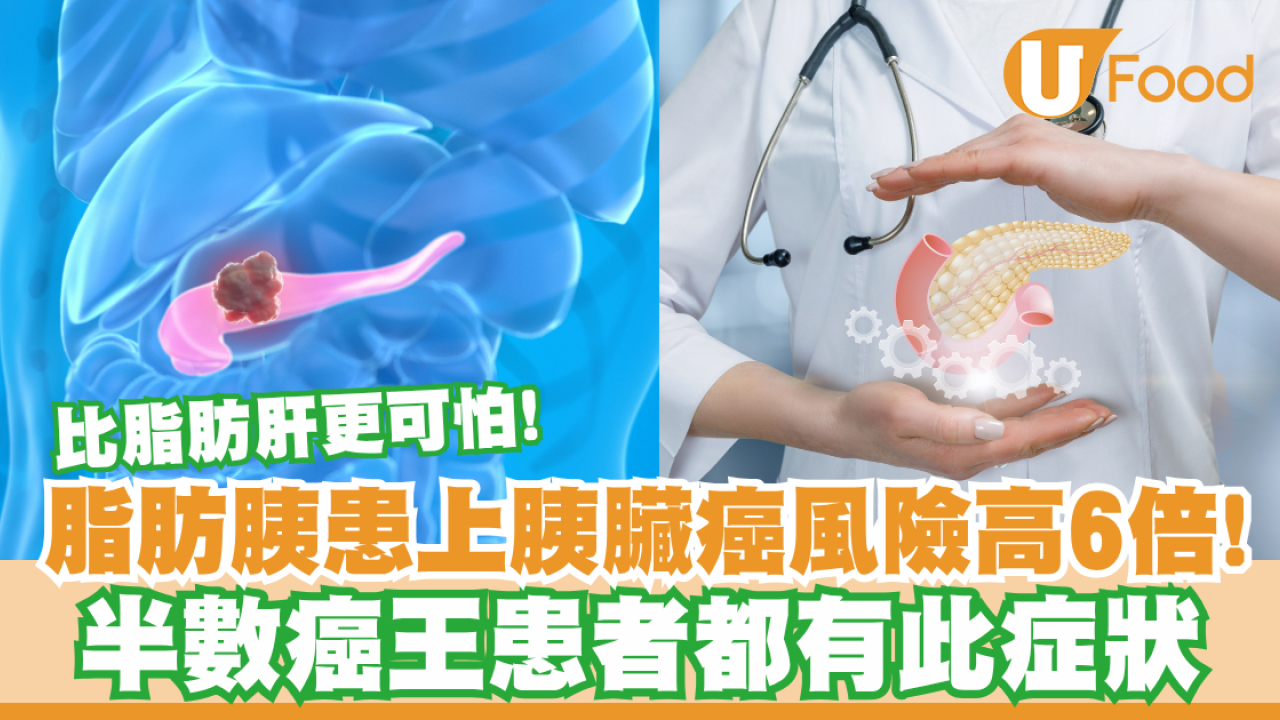 【胰臟癌】脂肪胰比脂肪肝更可怕！胰臟癌風險多6倍／半數癌王患者都有此症狀