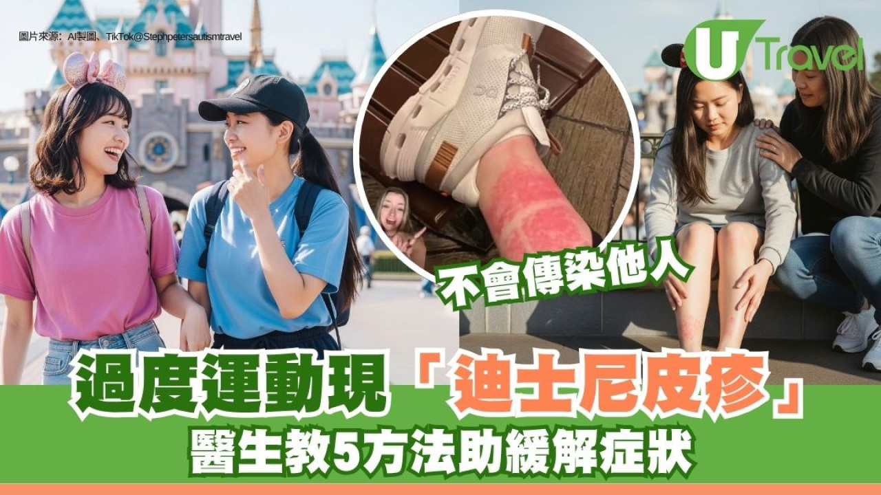 過度運動現「迪士尼皮疹」？醫生教5方法助緩解 50歲以上女性常發生！