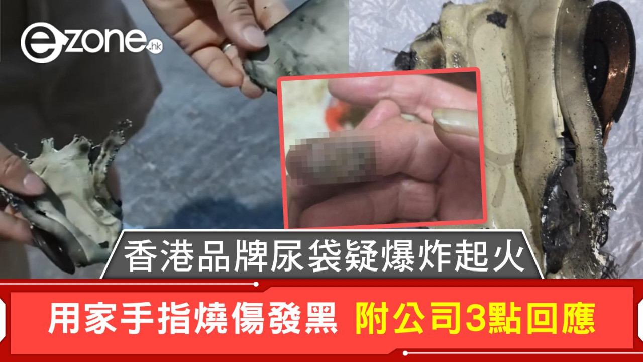 香港品牌尿袋疑爆炸起火 用家手指燒傷發黑 附公司3點回應