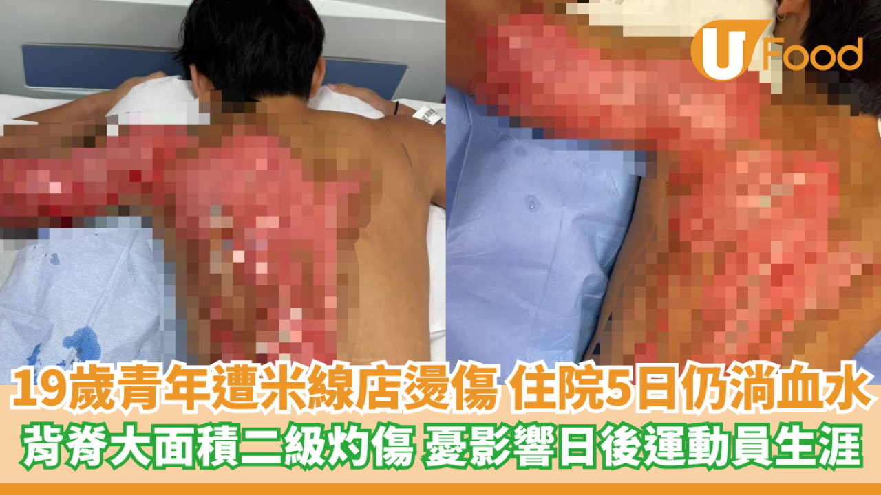 米線店燙傷19歲青年 背脊大面積二級灼傷 住院5日仍淌血水