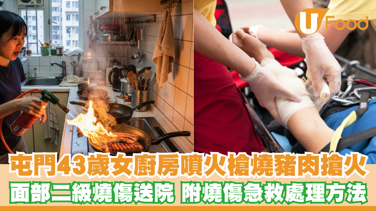 屯門43歲女廚房噴火槍燒豬肉搶火！面部二級燒傷送院  附燒傷急救處理方法