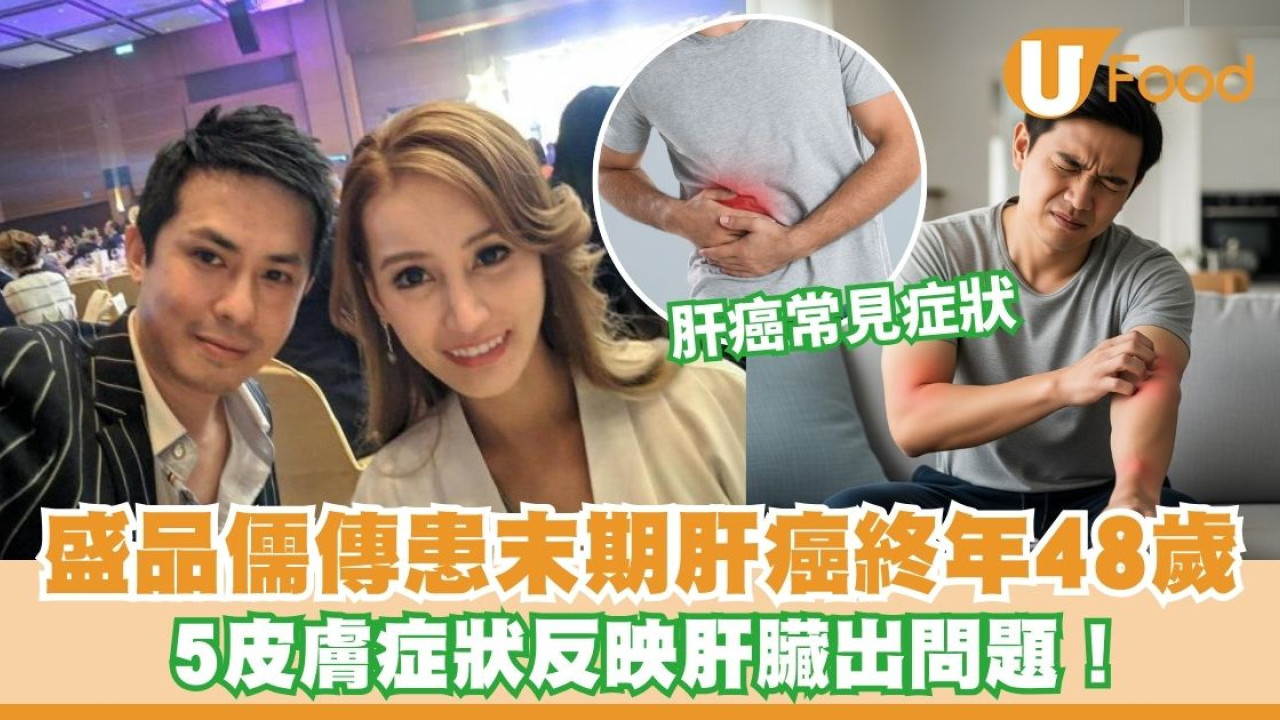 盛品儒什麼病？盛品儒驚傳末期肝癌終年48歲 5皮膚症狀反映肝臟出問題！