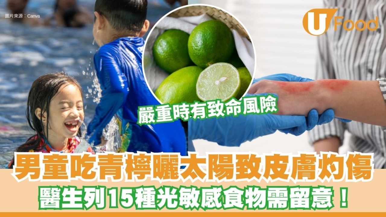 男童吃青檸後曬太陽 皮膚竟嚴重灼傷 醫生列15種光敏感食物需留意！