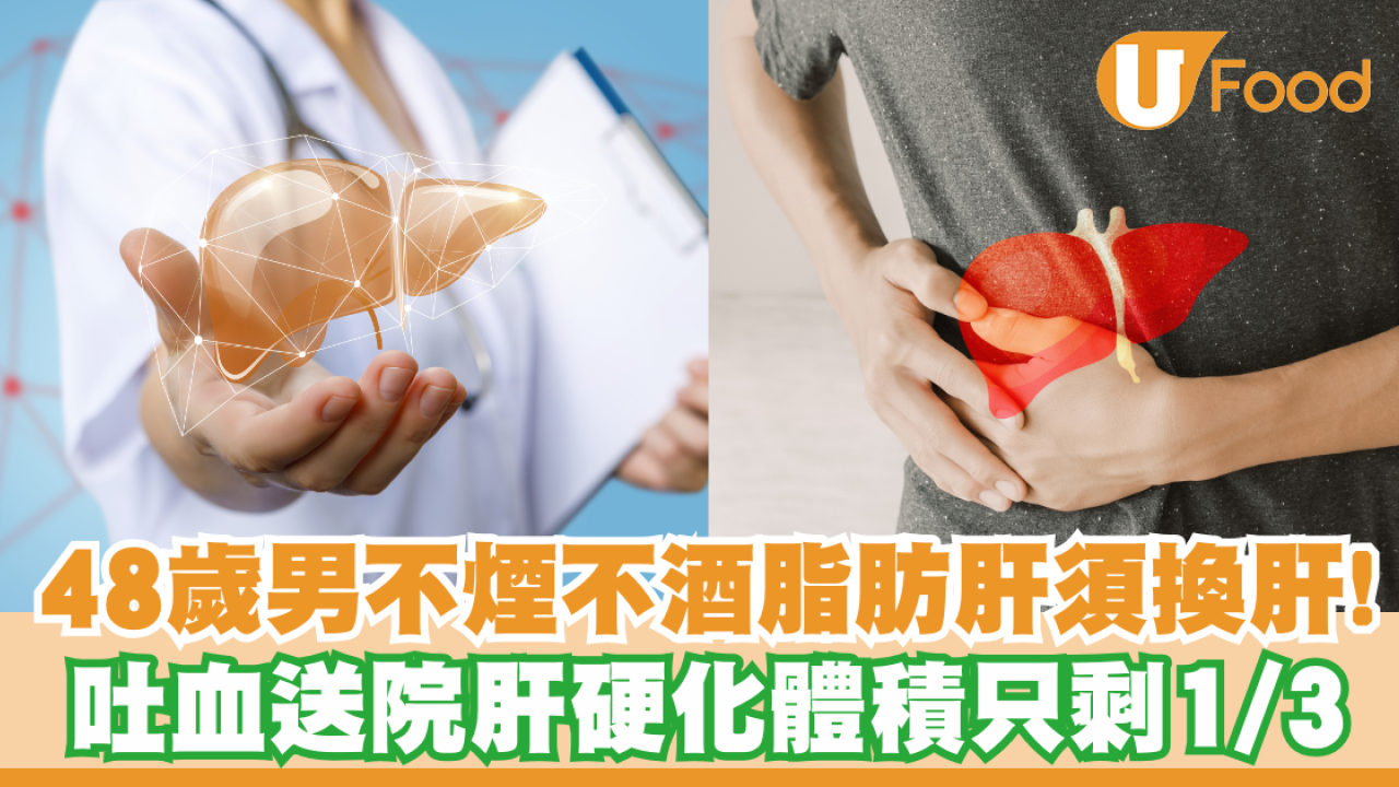 【脂肪肝】48歲男不煙不酒嚴重脂肪肝到須換肝！吐血送院肝硬化體積只剩1／3