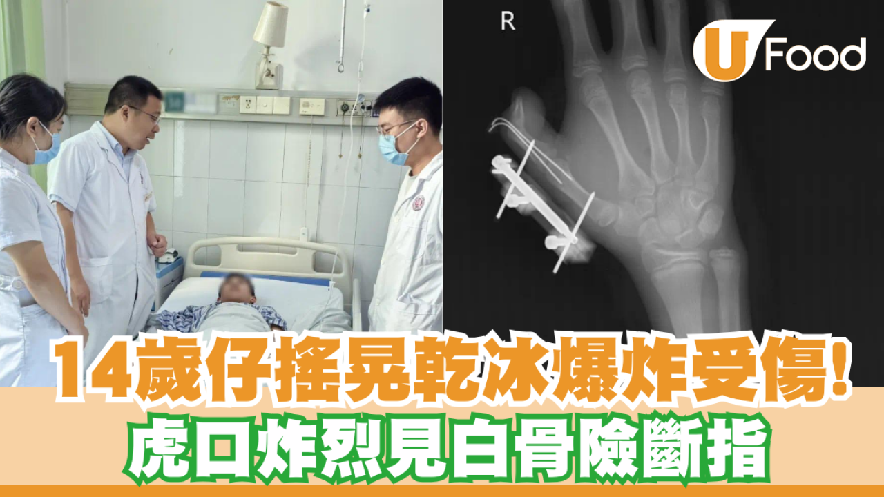 14歲仔搖晃乾冰爆炸受傷！虎口炸烈見白骨險斷