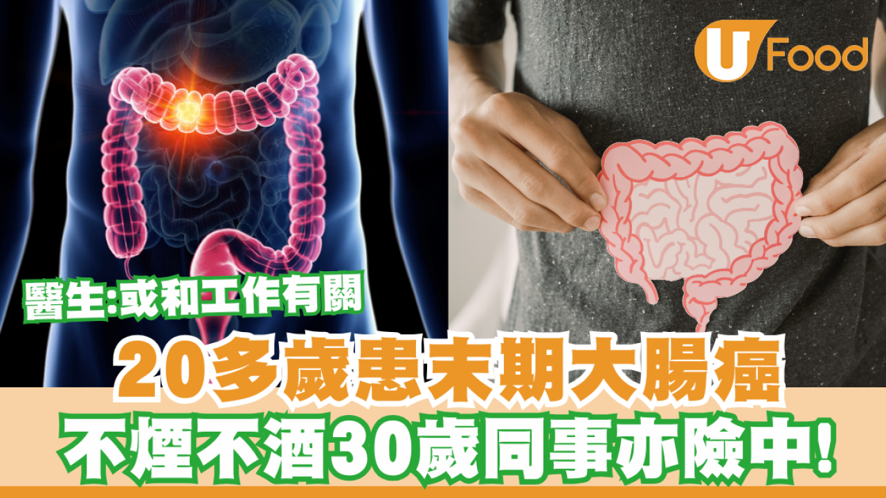 【大腸癌】20多歲患末期大腸癌  不煙不酒30歲同事亦險中！醫生：或和工作有關