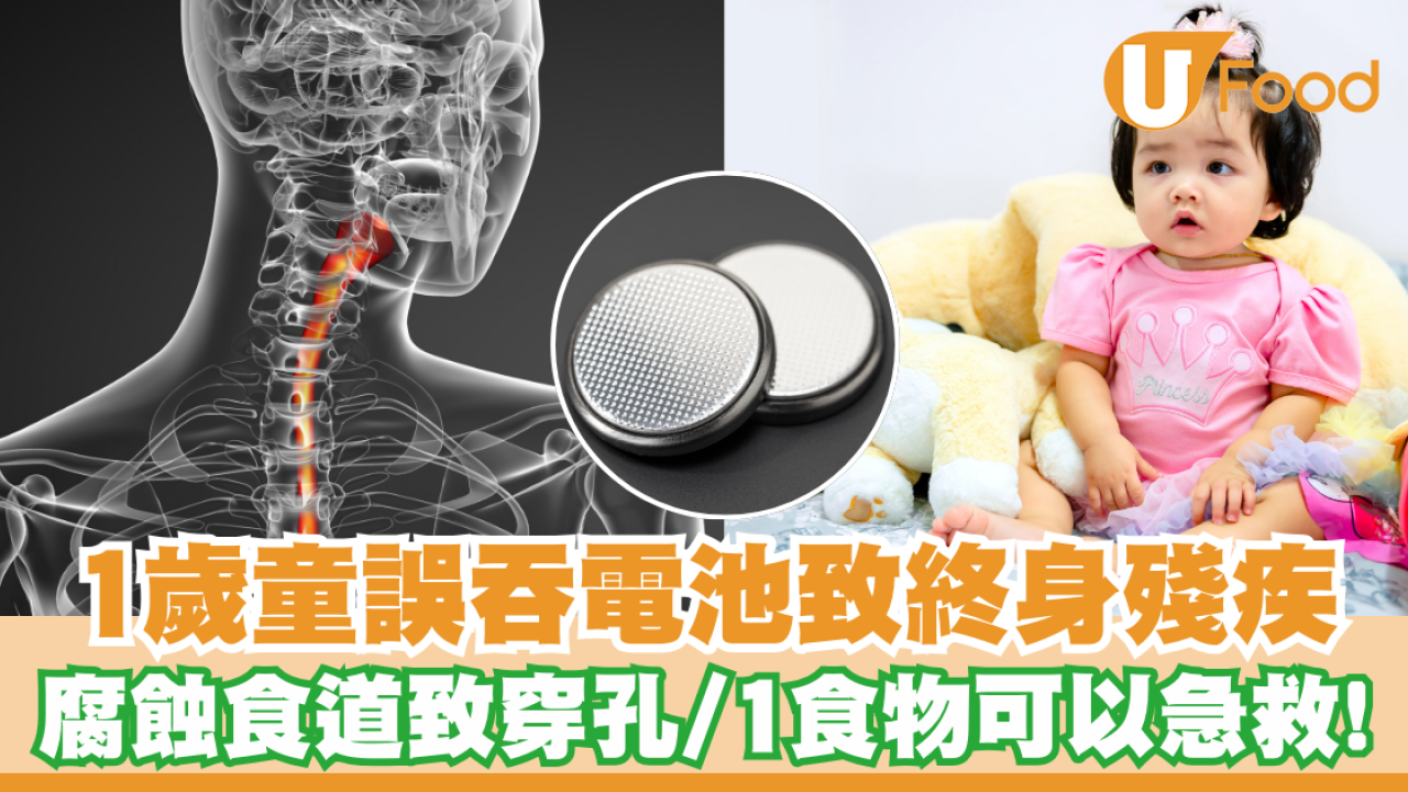 1歲童誤吞電池致終身殘疾！腐蝕食道致穿孔／1食物可以急救！