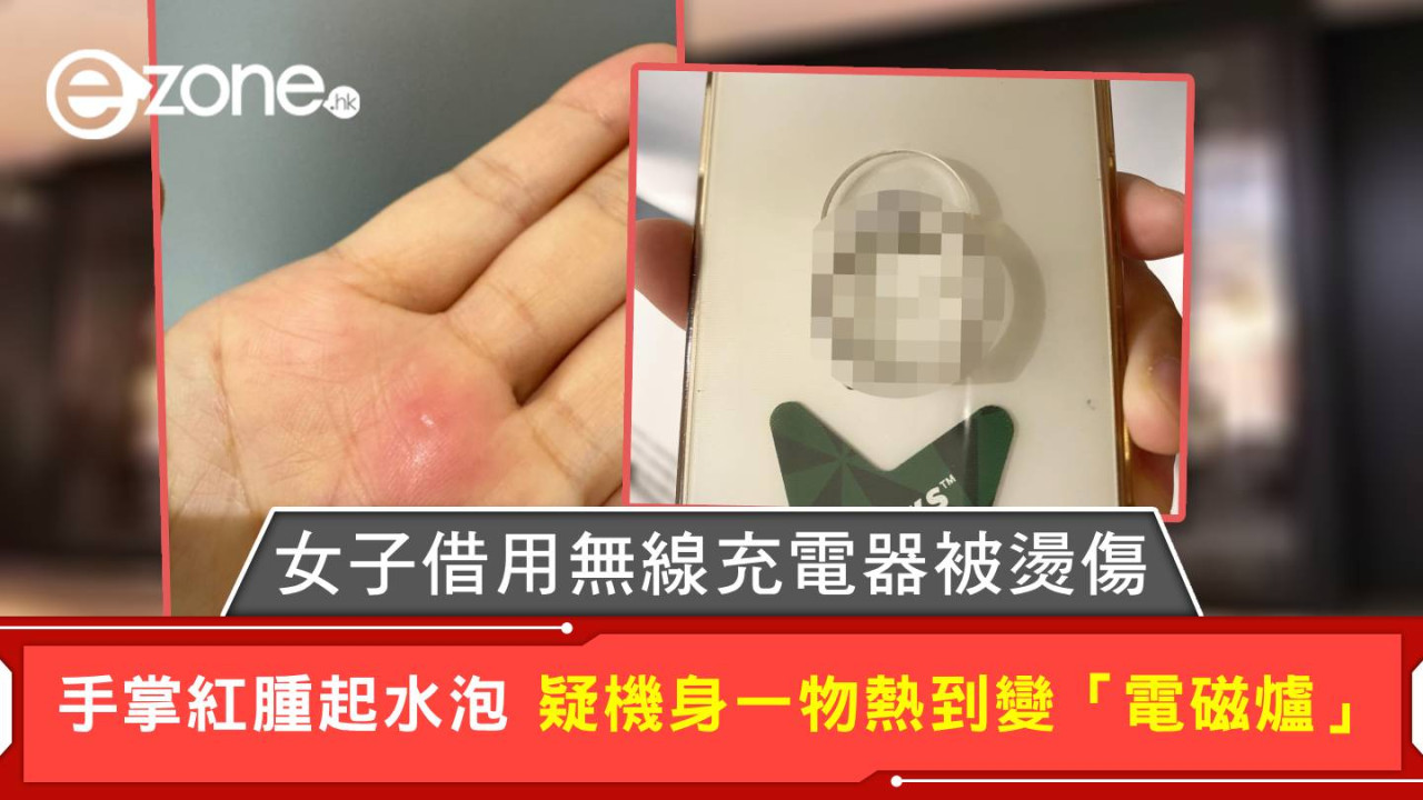 女子借用無線充電器被燙傷 手掌紅腫起水泡 疑機身一物熱到變「電磁爐」
