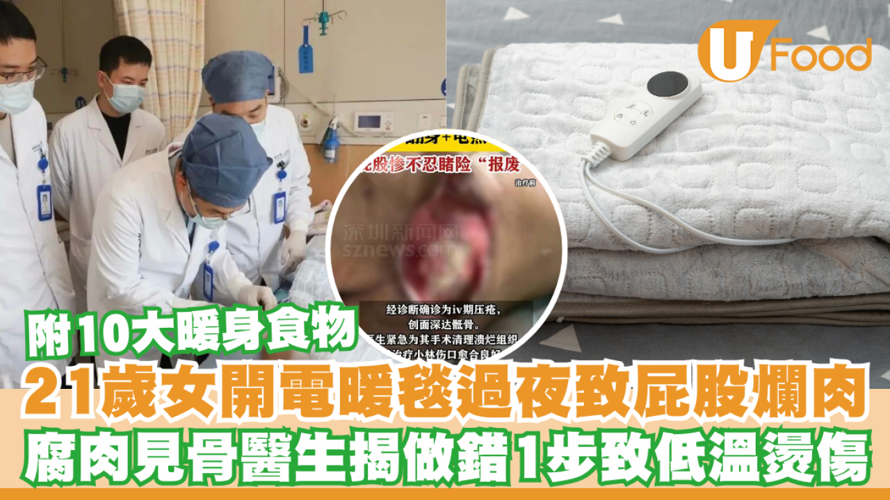 21歲女開電暖毯過夜致屁股爛肉見骨！醫生揭做錯1步致低溫燙傷／附10大暖身食物