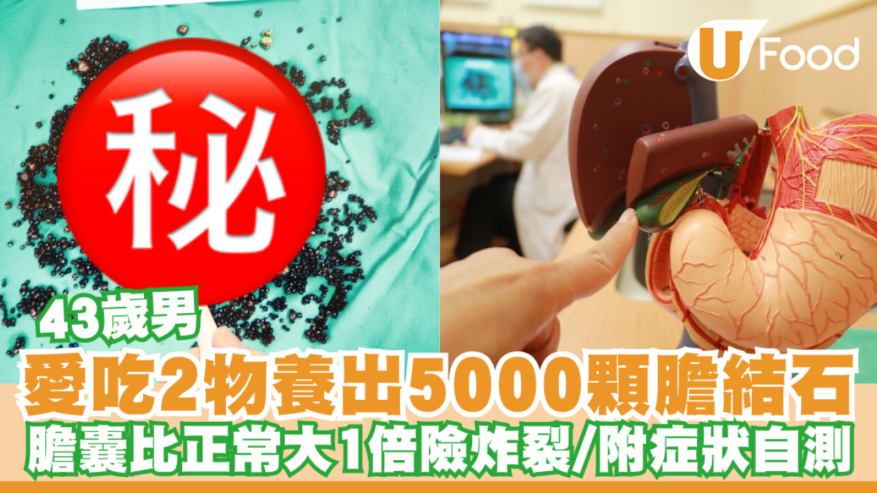 43歲男愛吃2物養出5000顆膽結石！膽囊比正常大1倍險炸裂／曾以為胃病險誤診(附症狀自測)