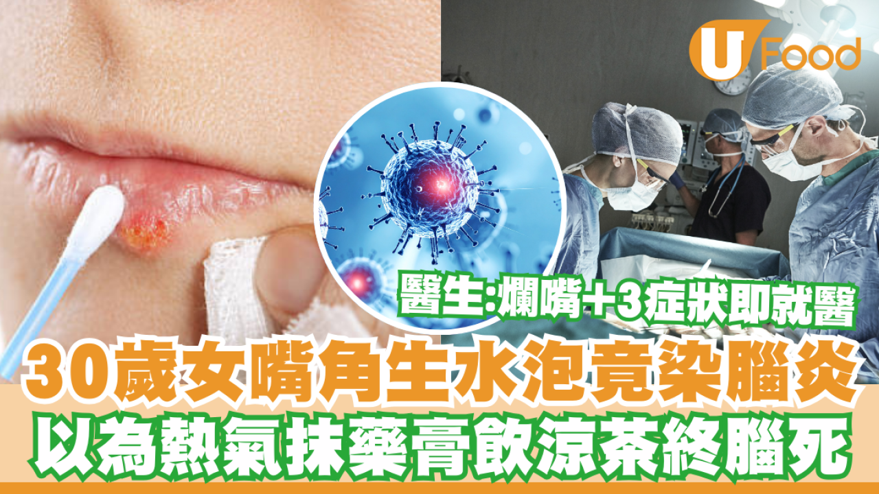 30歲女嘴角生水泡竟是腦炎症狀！以為熱氣沒重視終不治／醫生：爛嘴伴隨3症狀要即就醫