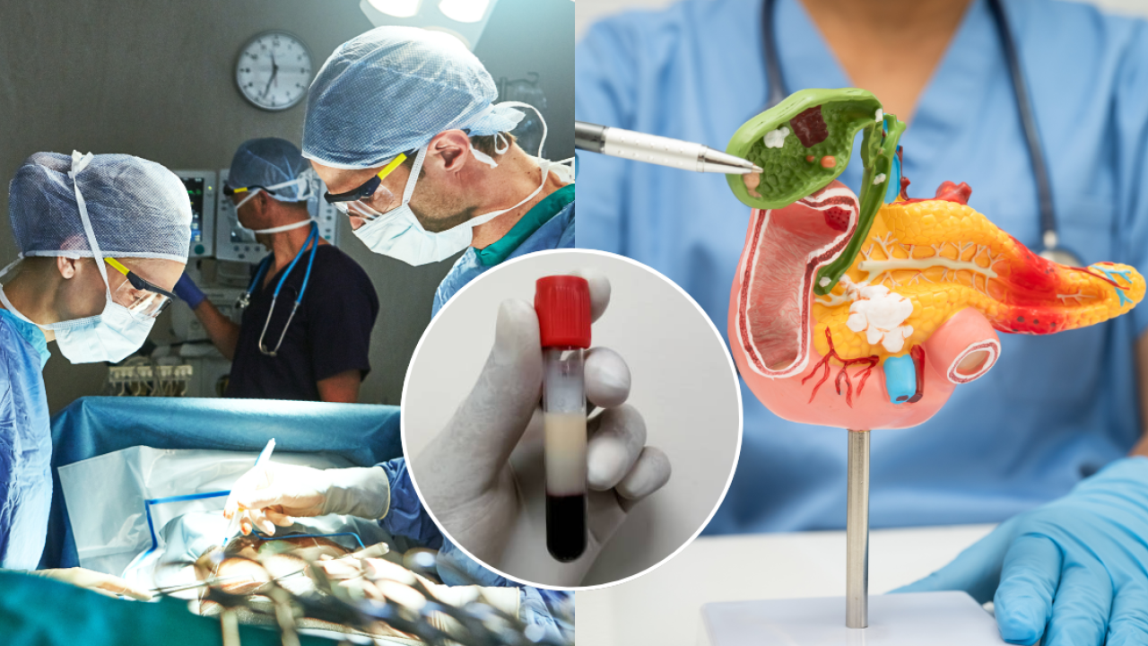 28歲男突發胰腺炎劇痛送院搶救！抽血驚見「豬油血」險死／醫生：全因愛吃3物...