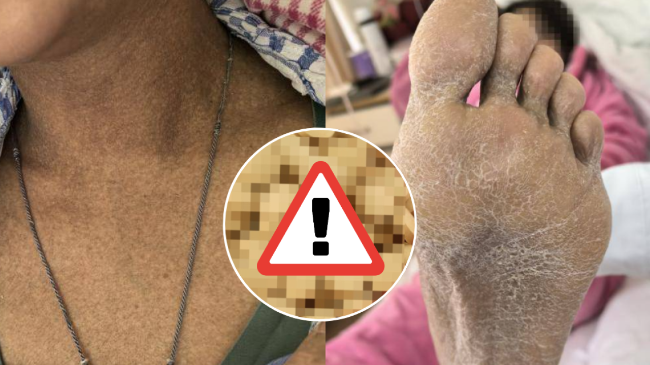 35歲女長期食1「保健品」治便秘中砒霜毒！全身+大腸變黑／醫生警告嚴重可致器官衰竭