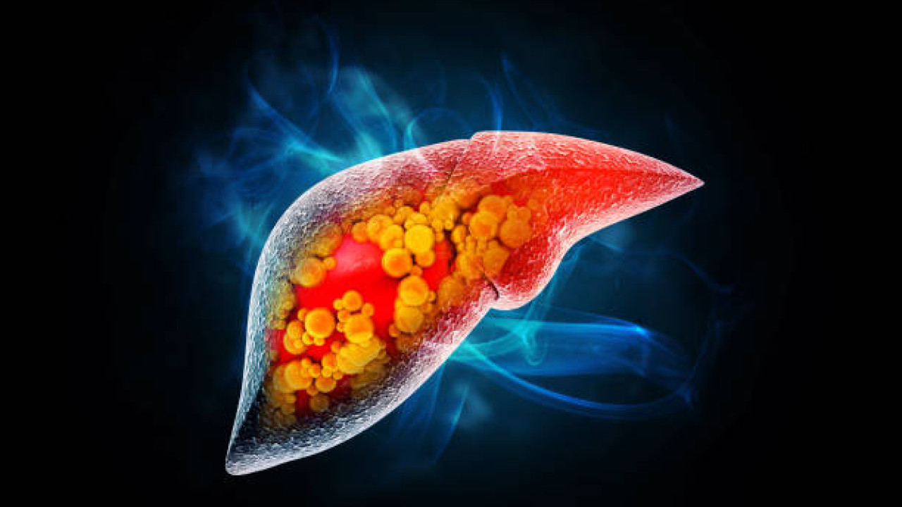 男子無痛楚僅肚瀉3個月驚揭末期肝癌！醫生嘆：肝臟已密密麻麻塞滿 揭1致命病史