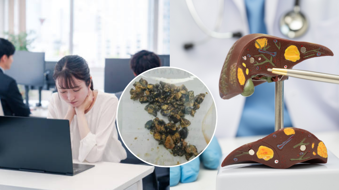膽結石成因｜35歲女長期不吃早餐生60粒膽石！醫生解構右上腹痛先兆/營養師7大飲食預防法