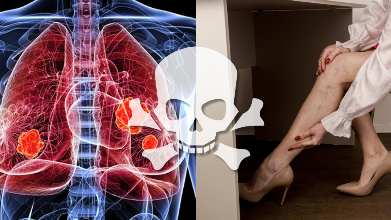肺癌症狀/前兆｜55歲女完全無咳竟揭肺癌末期 醫生嘆：癌細胞已吃掉腿骨