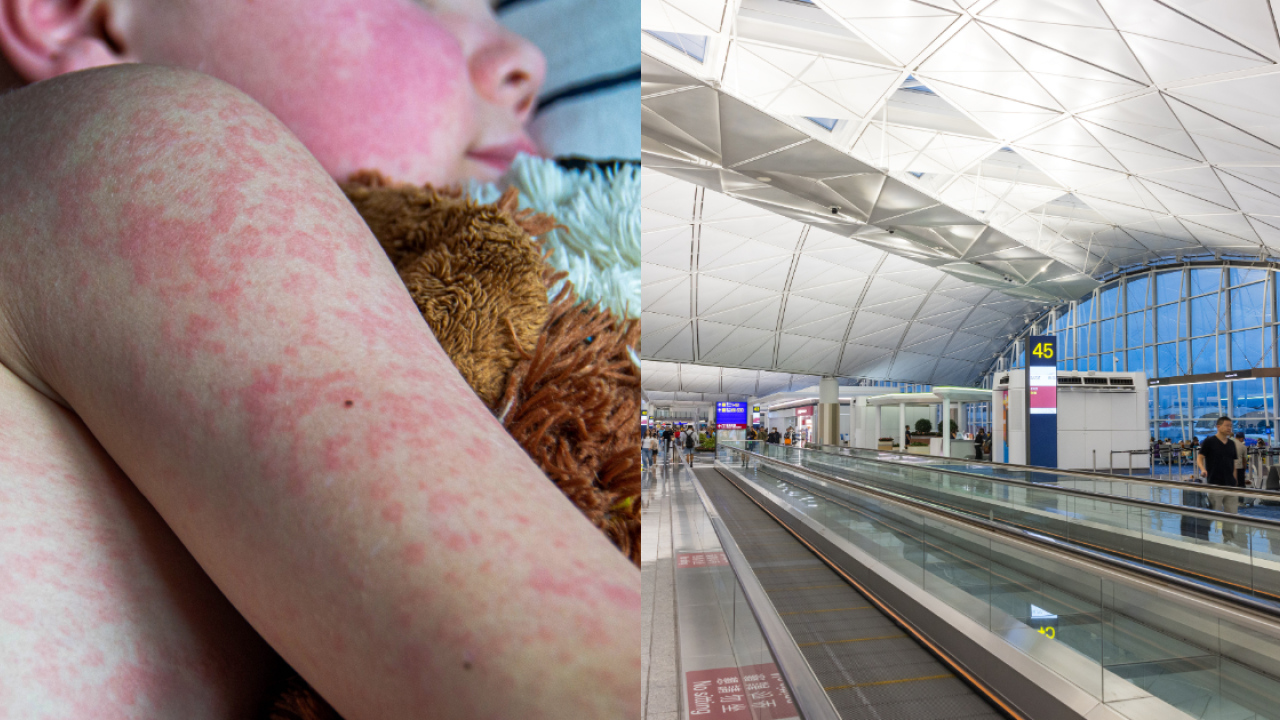 香港機場爆麻疹群組！衞生署設免費疫苗站/即睇5大高危病徵/附1防麻疹解熱毒湯水