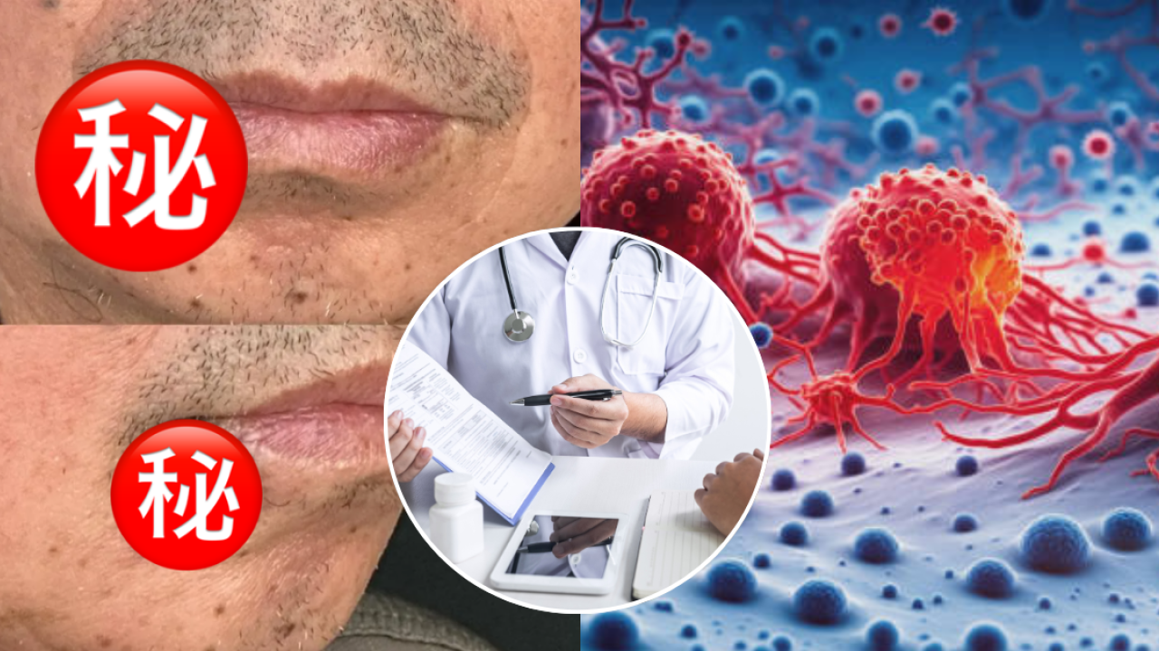 以為熱氣生暗瘡？57歲男嘴邊長痘拖幾年 驚變潰爛大腫瘤患皮膚癌