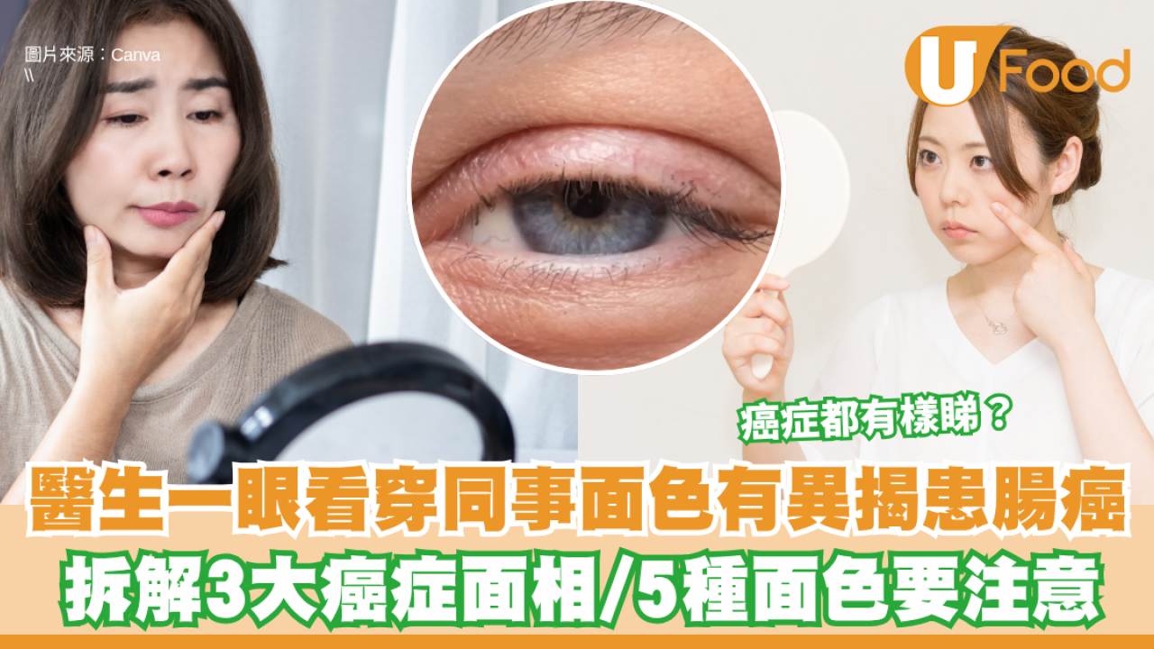 癌症都有樣睇？醫生一眼看穿同事面色有異揭患腸癌 拆解3大癌症面相