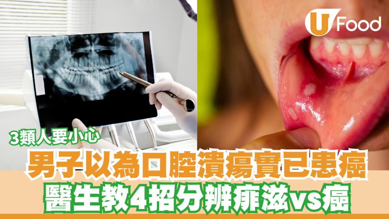 以為熱氣生痱滋？男子舌頭白點唔痛驚揭患癌！醫生警告14天不癒屬極高危