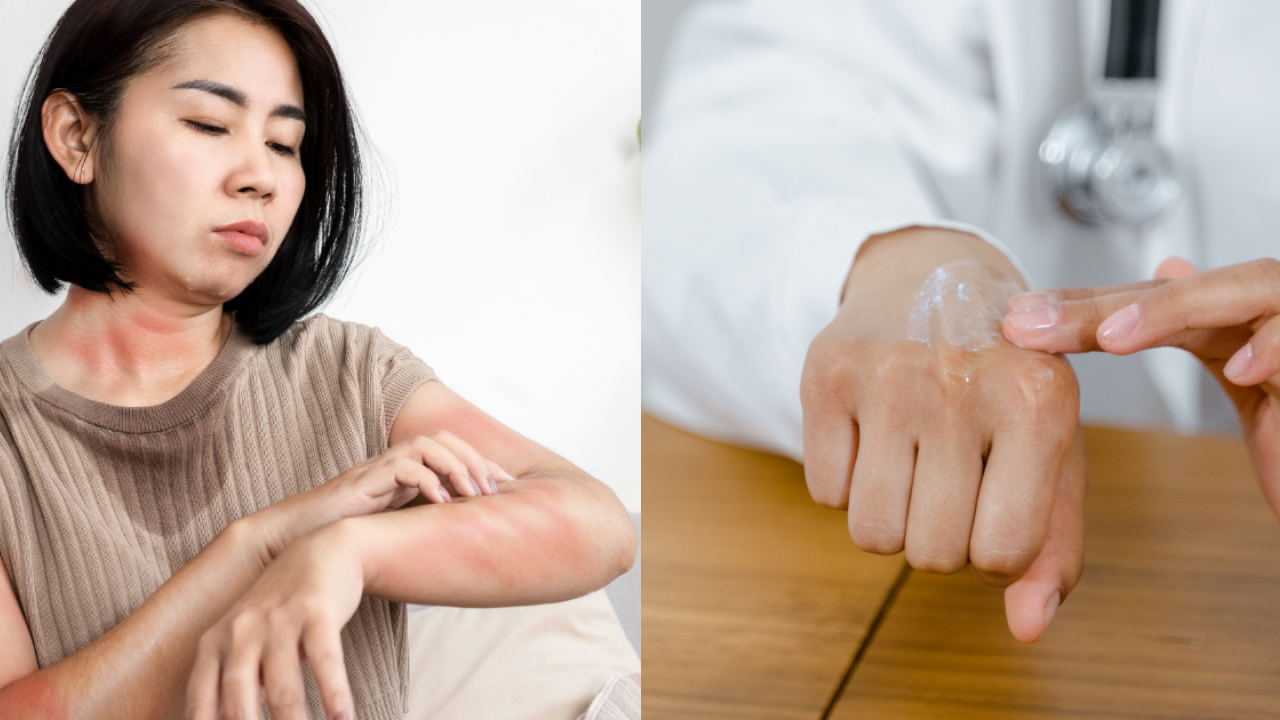 以為濕疹竟是癌症！醫生驚揭1類皮膚癌極易誤診／倪匡生前亦曾中伏