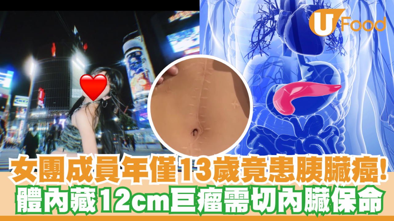 13歲女竟患胰臟癌！人氣女團成員體內藏12cm巨瘤需切內臟保命／附胰臟癌6大病徵