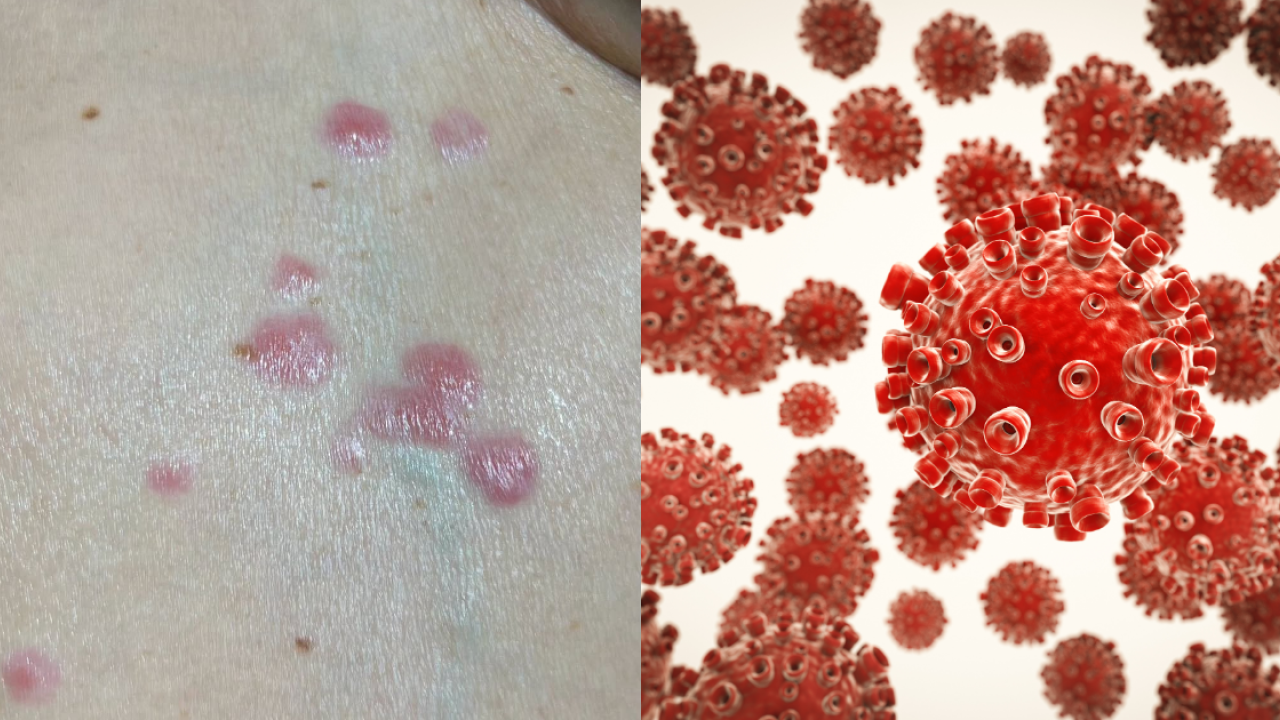 腹部生紅疹以為普通濕疹？70歲婦不痛不癢驚查竟是乳癌皮膚轉移／醫生警告5大症狀即就醫
