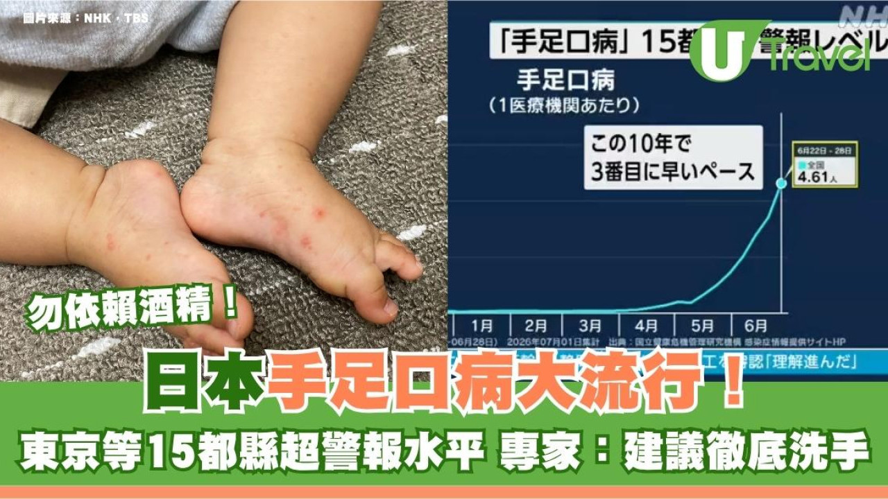 遊日注意｜日本手足口病大流行！東京等15都縣超警報水平 專家：建議徹底洗手勿依賴酒精