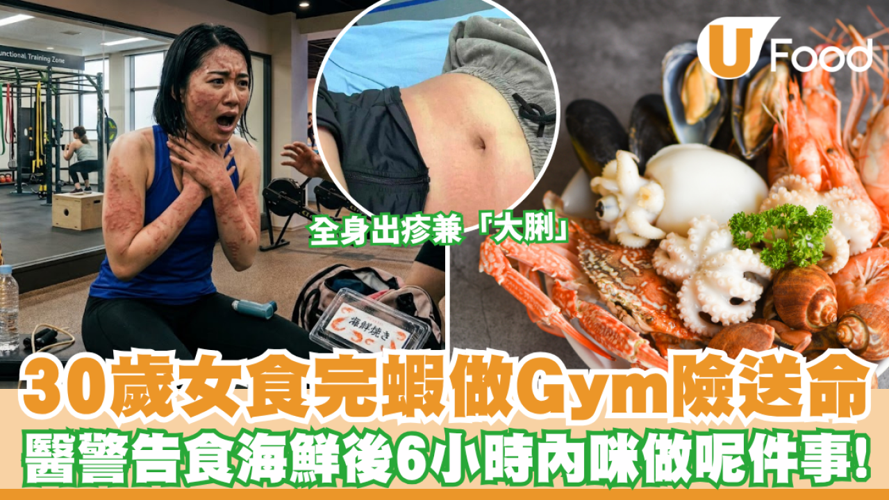 海鮮禁忌｜食完蝦去做Gym險送命！30歲女全身出疹兼「大脷」 醫生警告：食海鮮後6小時內千祈咪做呢件事！