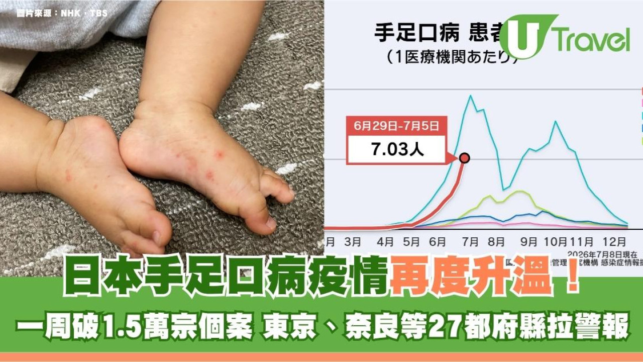 日本手足口病疫情再度升溫！一周破1.5萬宗個案 東京、奈良等27都府縣拉警報