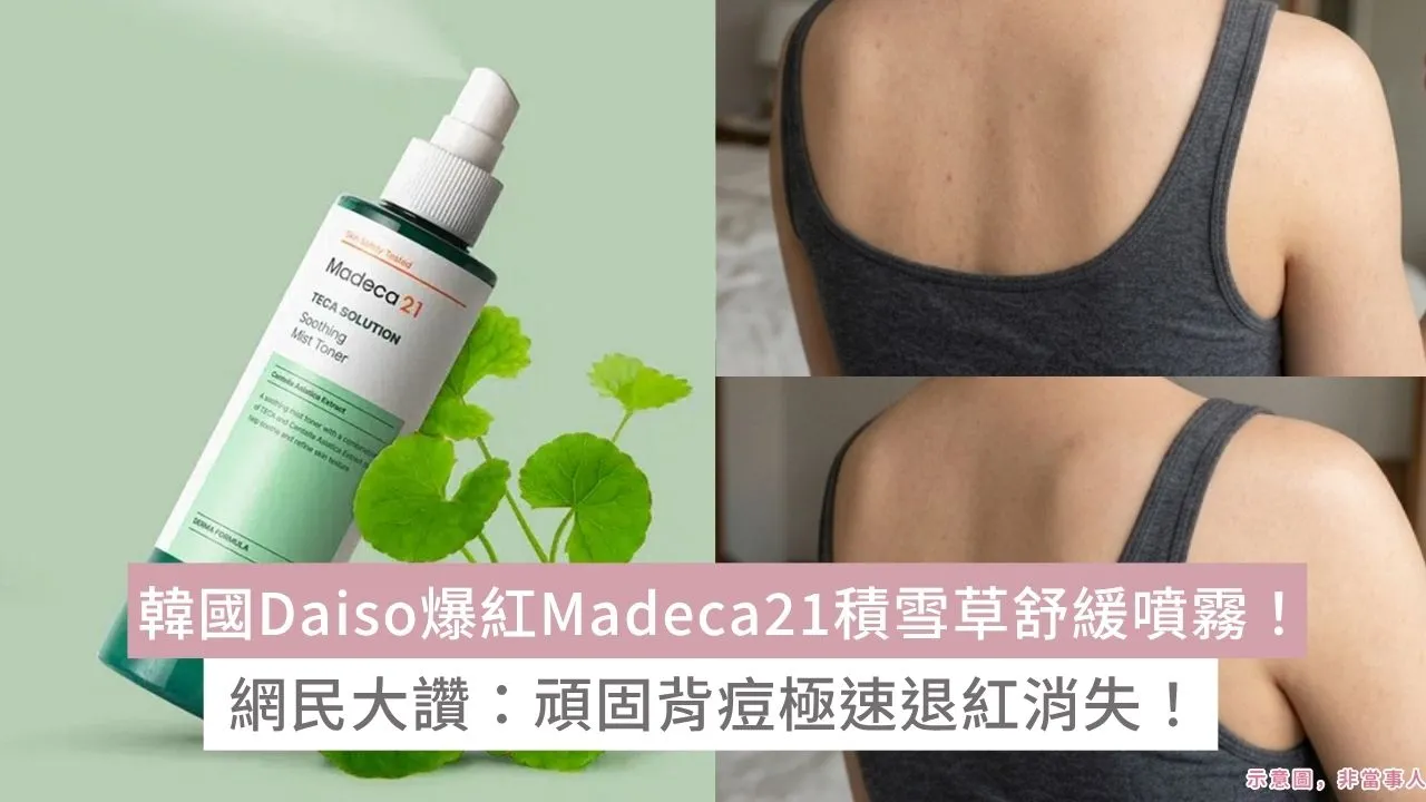 韓國Daiso爆紅Madeca21積雪草舒緩噴霧！網民大讚：頑固背痘極速退紅消失！