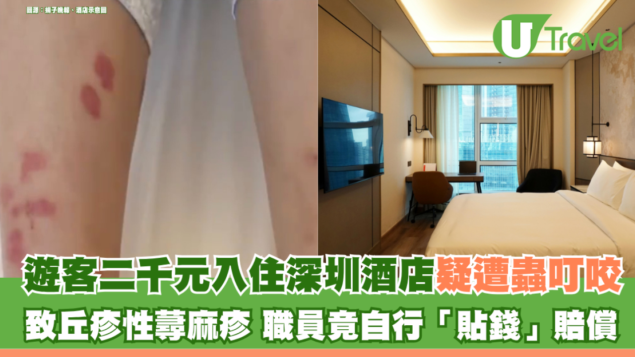 遊客二千元入住深圳酒店疑遭蠓蟲叮咬 致丘疹性蕁麻疹 酒店職員竟自行「貼錢」賠償惹爭議