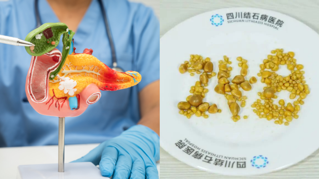 26歲打工仔生248粒膽結石！劇痛送院膽囊被塞爆／醫嘆1飲食惡習血脂超標逾5倍