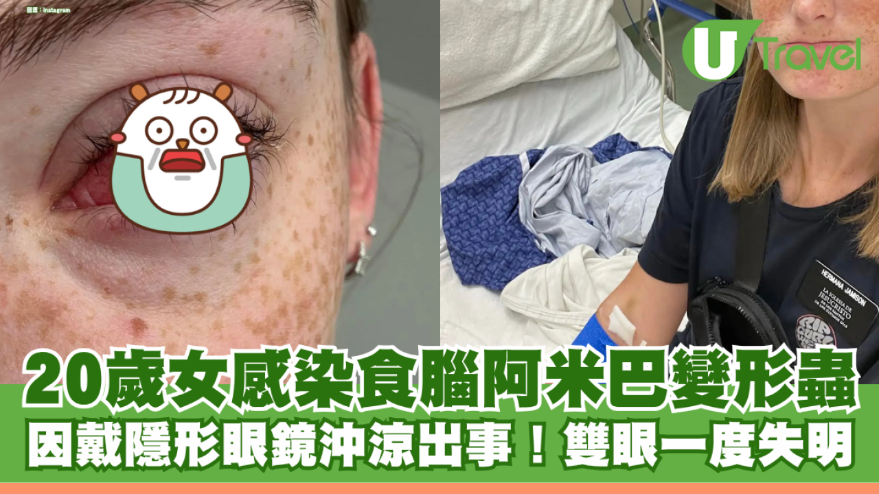 戴隱形眼鏡沖涼出事！美國20歲女感染食腦阿米巴變形蟲 雙眼一度失明一年未康復