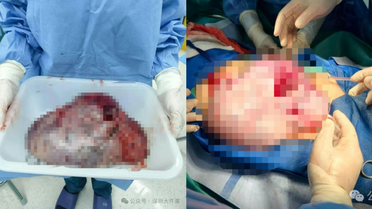 11歲女以為發育肥竟是生4kg畸胎瘤！學校跑步突劇痛送院開刀／醫生籲4大警號
