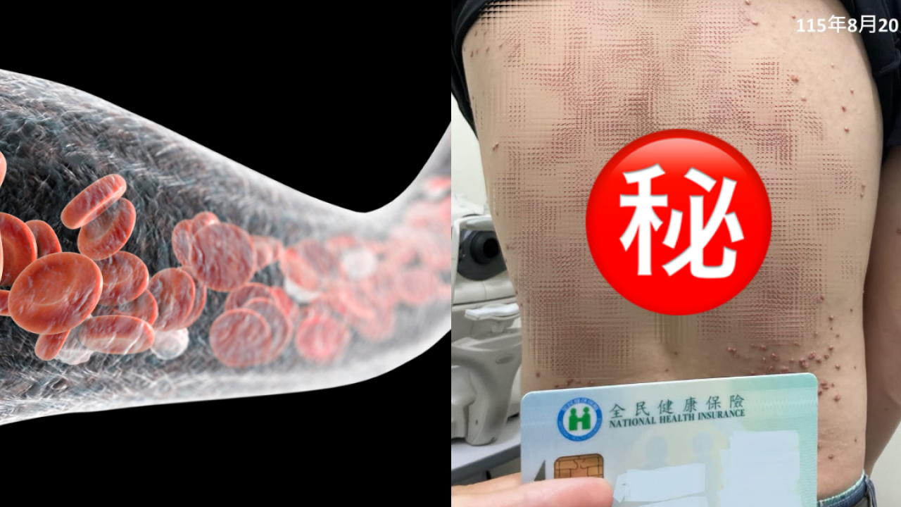 23歲男血糖失控背生過百粒黃紅色瘤！恐怖過梅毒曾3度患胰臟炎／醫：致死率極高