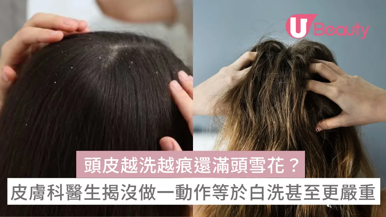 頭皮越洗越痕還滿頭雪花？皮膚科醫師揭沒做一動作等於白洗甚至更嚴重！
