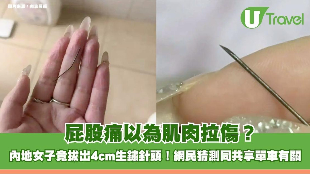 屁股痛以為肌肉拉傷？內地女子竟拔出4cm生鏽針頭！網民猜測同共享單車有關