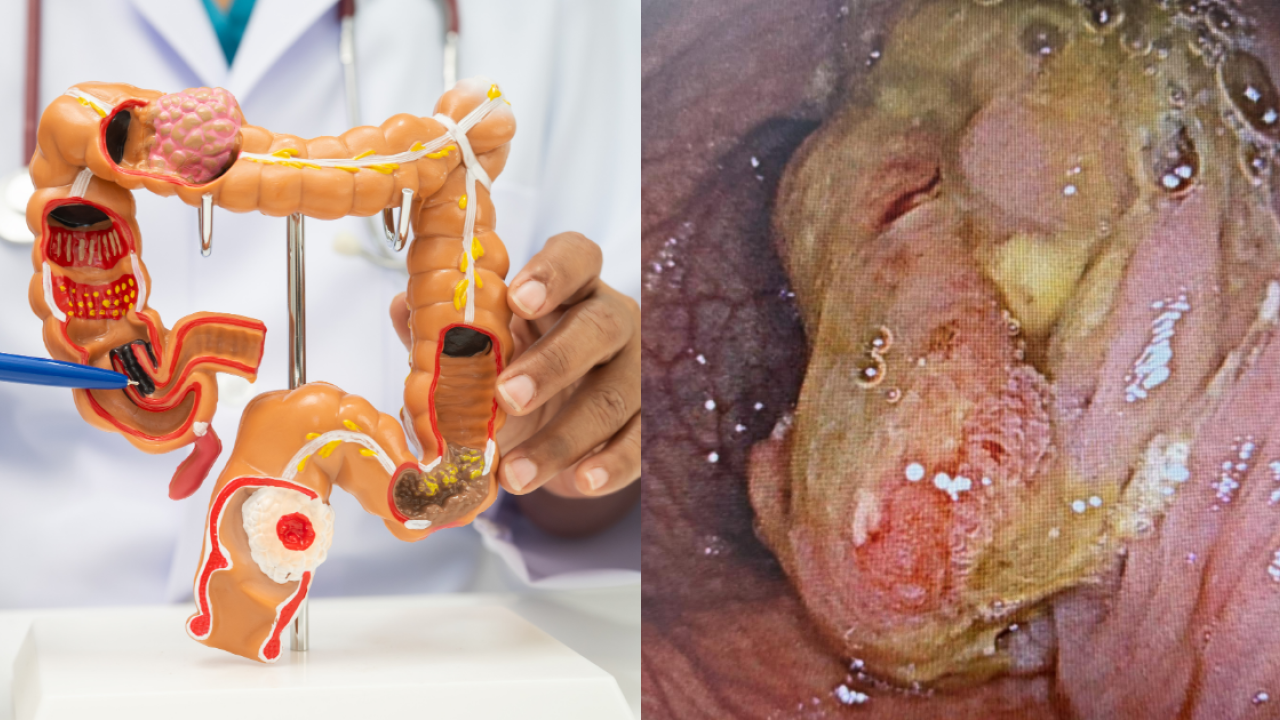 50歲男無不適0症狀竟已患大腸癌！腫瘤爆生已轉移至肝臟／醫點名6高危養癌壞習慣
