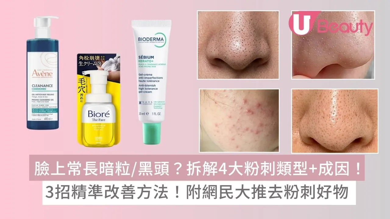 臉上常長暗粒/黑頭？拆解4大粉刺類型+成因！3招精準改善方法+網民大推去粉刺好物！