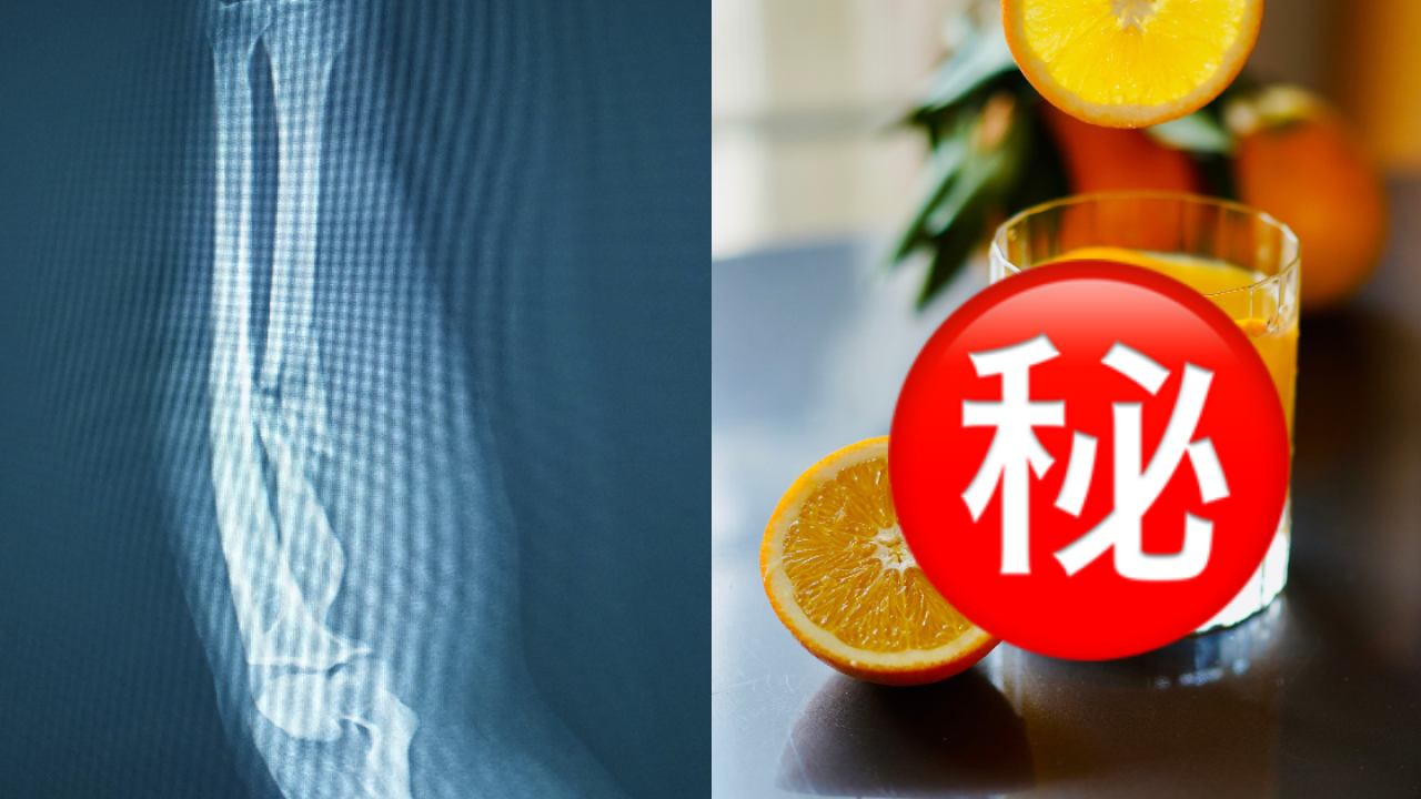 專家列3高危飲品可致骨折風險飆4.7倍！這款常見早餐同是幫兇／養成3良好習慣助力挽狂瀾