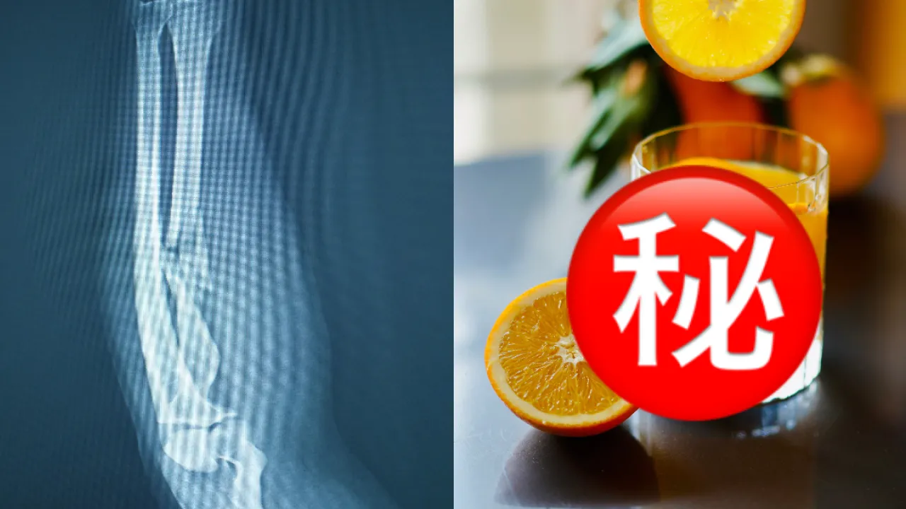 專家列3高危飲品可致骨折風險飆4.7倍！這款常見早餐同是幫兇／養成3良好習慣助力挽狂瀾