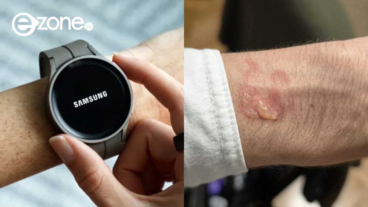 戴 Galaxy Watch 睡覺遭燙傷？多名苦主手腕驚現紅斑水泡　外媒拆解原因【附 5 招安全佩戴貼士】