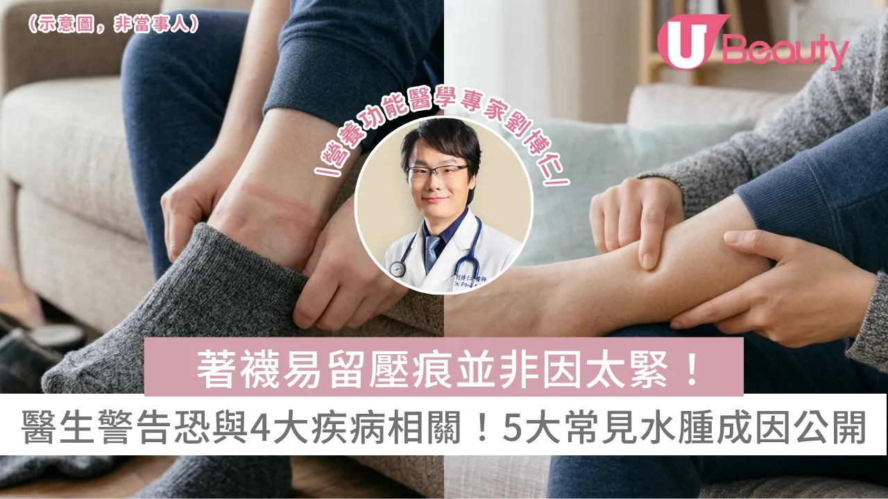 著襪易留壓痕並非因太緊！醫生警告恐與4大疾病相關！5大常見水腫成因公開