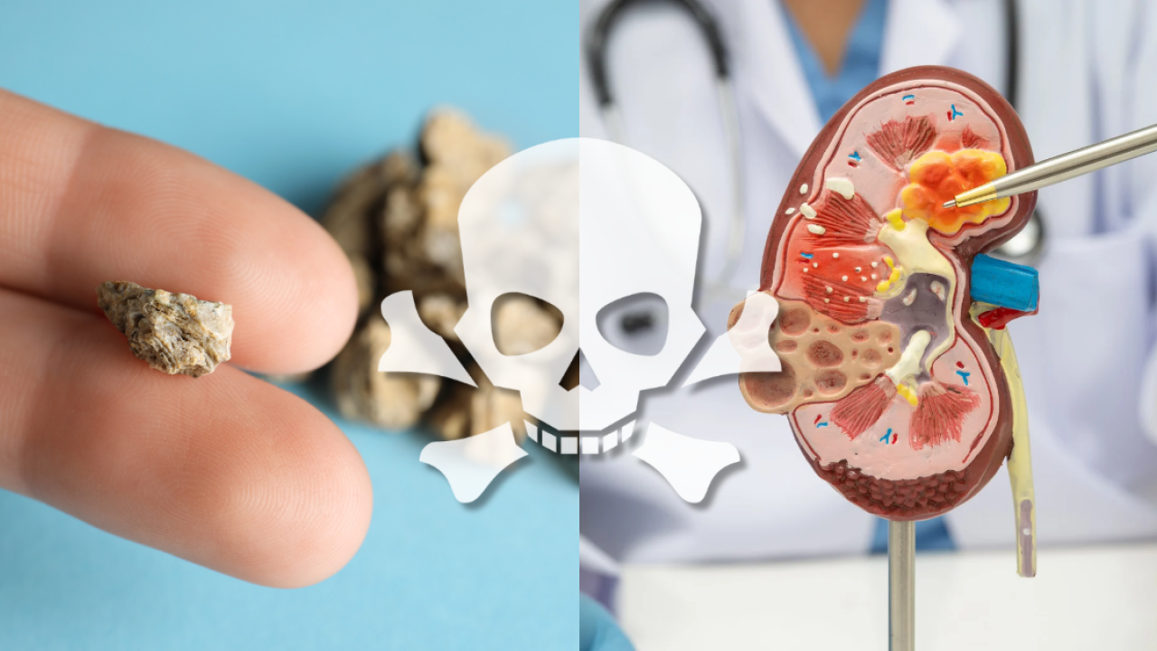 30歲男結石康復不足兩年又復發！半夜劇痛血尿輸尿管塞死入院／醫生： 復發率高達75%