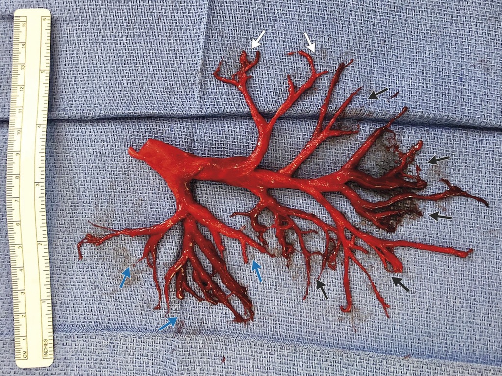 美國病人「咳到甩肺」？咳出支氣管樹狀血塊後死亡