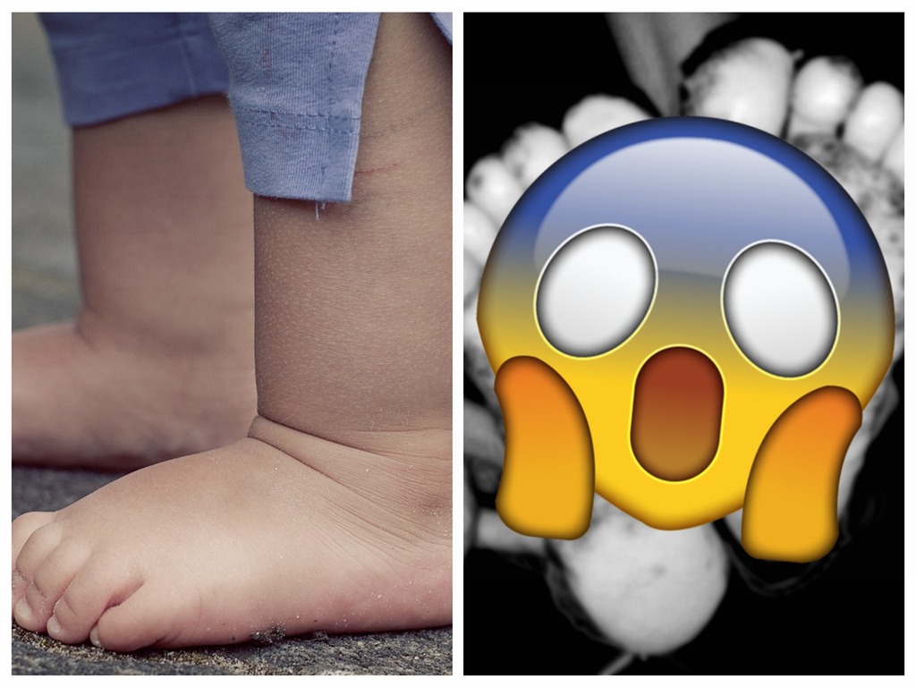 10 歲女童赤腳走被蚤咬！ 腳板底爛肉滿佈膿瘡【恐怖慎入】