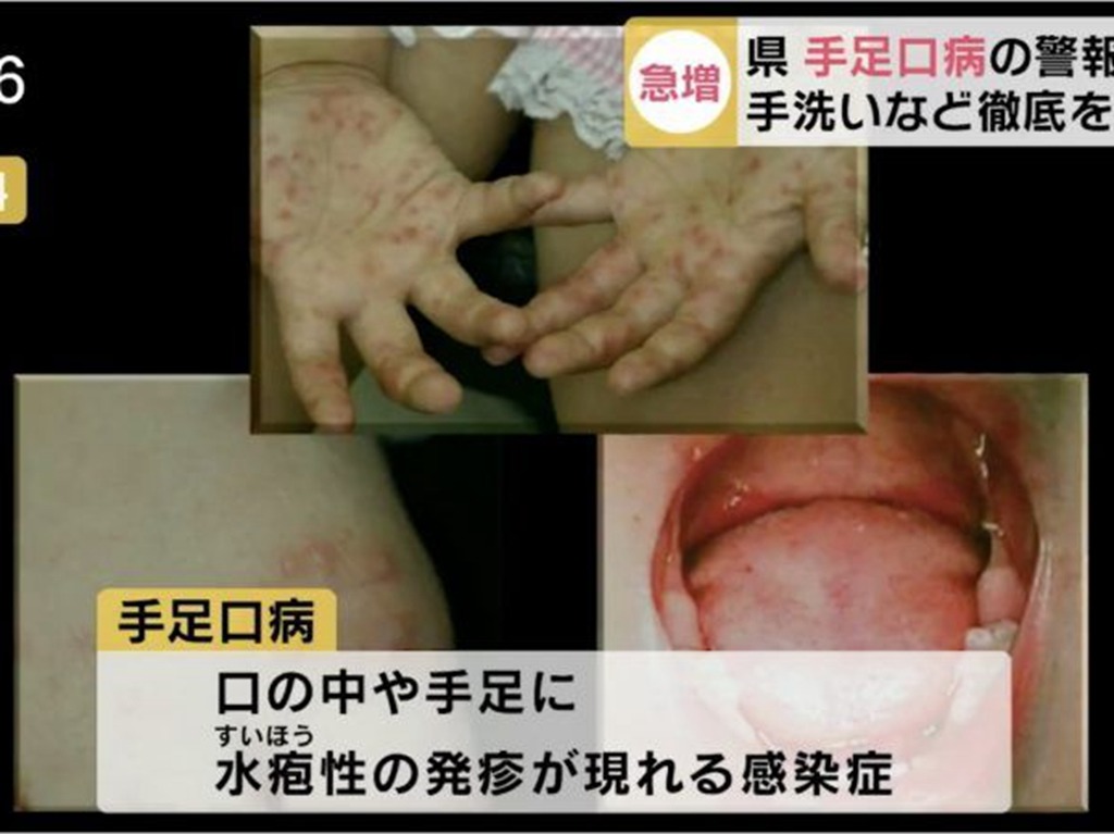 日本多個地方爆發手足口病 已超越警戒級別