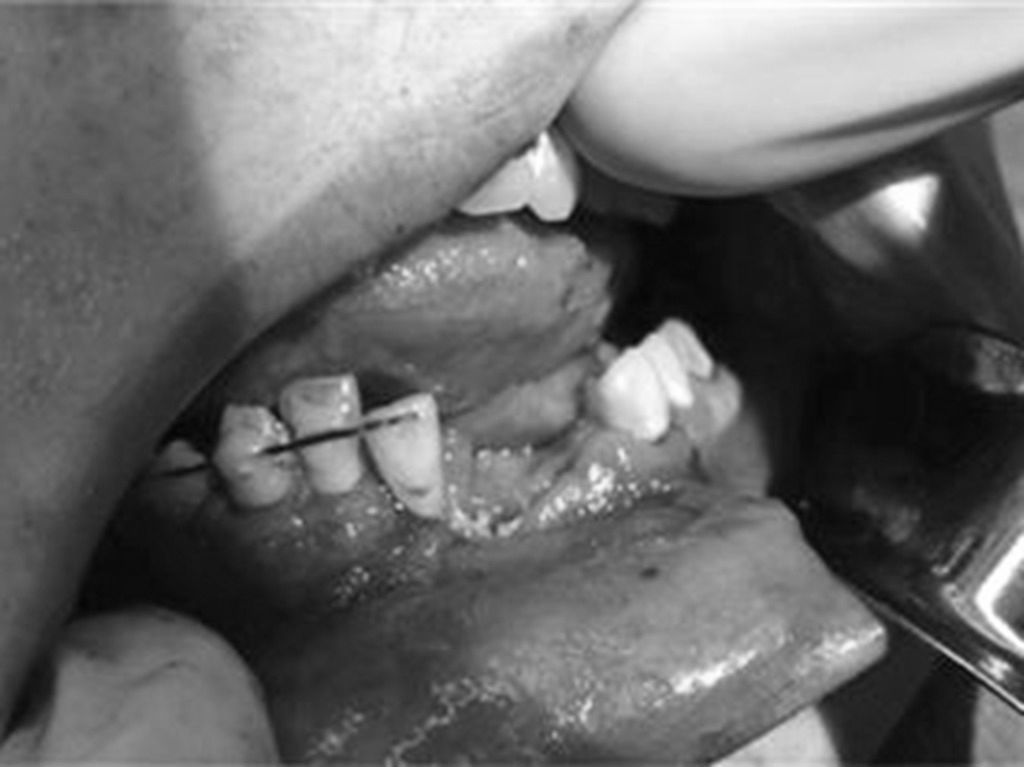 電子煙口中爆炸 少年牙齒被炸飛下顎骨折