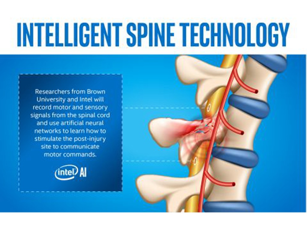 癱瘓者有望靠 AI 恢復活動能力  Intel 聯同醫學界研智能脊柱